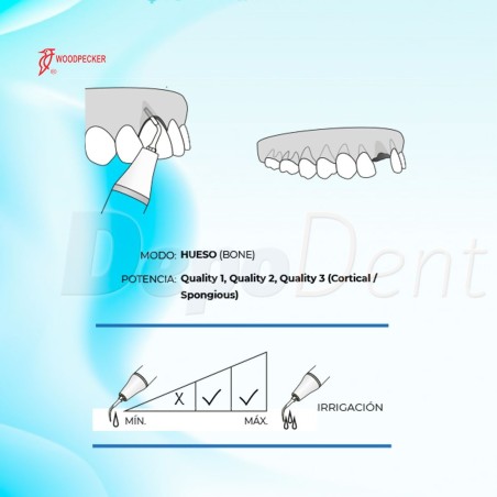 Puntas Cirugía UC1 para extracción compatibles con Mectron