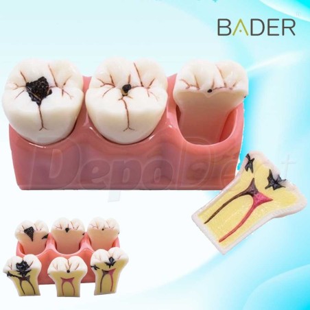 Modelo gigante caries marca Bader