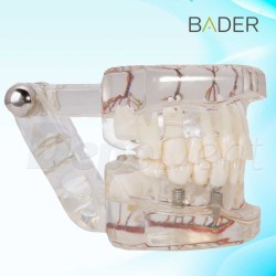 Modelo dental de implante con nervio Vista